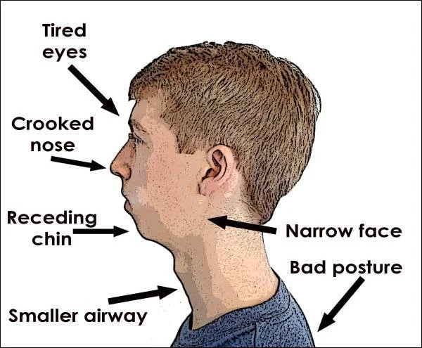 TMJ Disorder: Symptoms, Causes, and Treatment Options