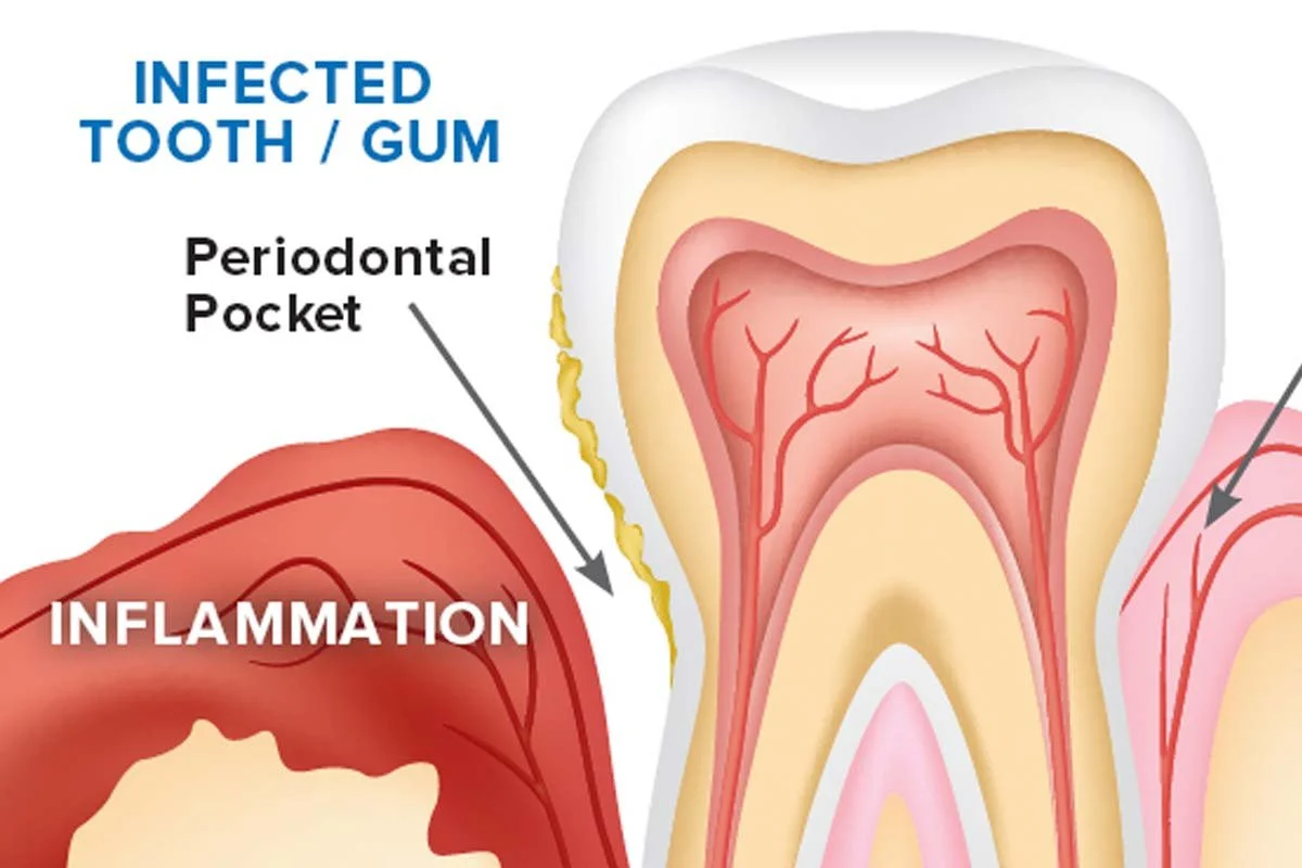 Gum Disease and Overall Health: Why Healthy Gums Matter More Than You Think