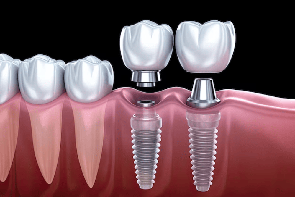 Dental Implants: Why They Are the Best Tooth Replacement Option