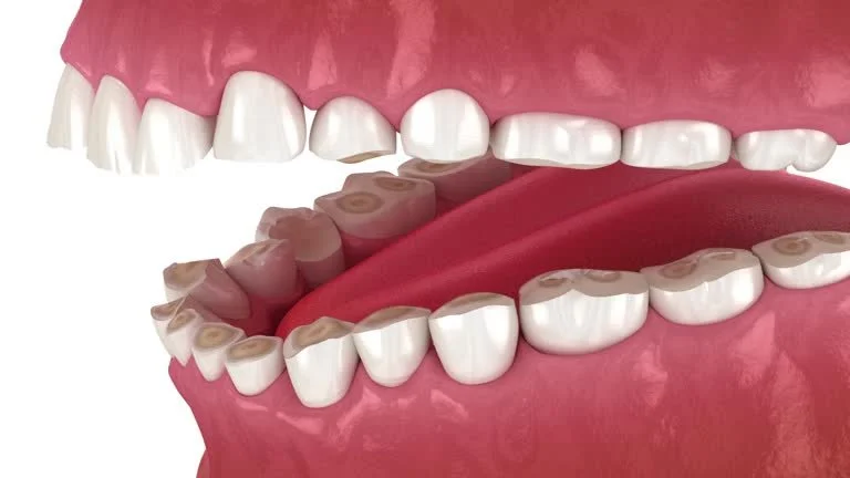 Teeth Grinding (Bruxism), TMJ Disorder, and Chronic Muscle Aches: What Your Body May Be Telling You