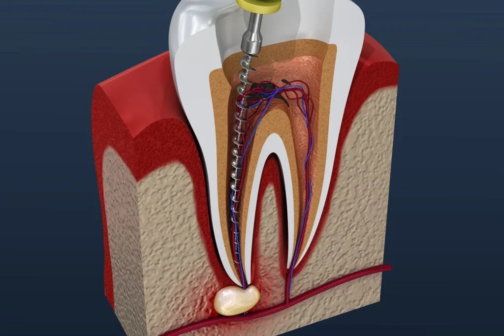 Root Canal Treatment: Why It Is Important for Saving Your Natural Tooth