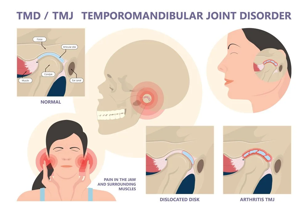 Can Braces Cause TMJ Problems Years Later? What Patients Should Know