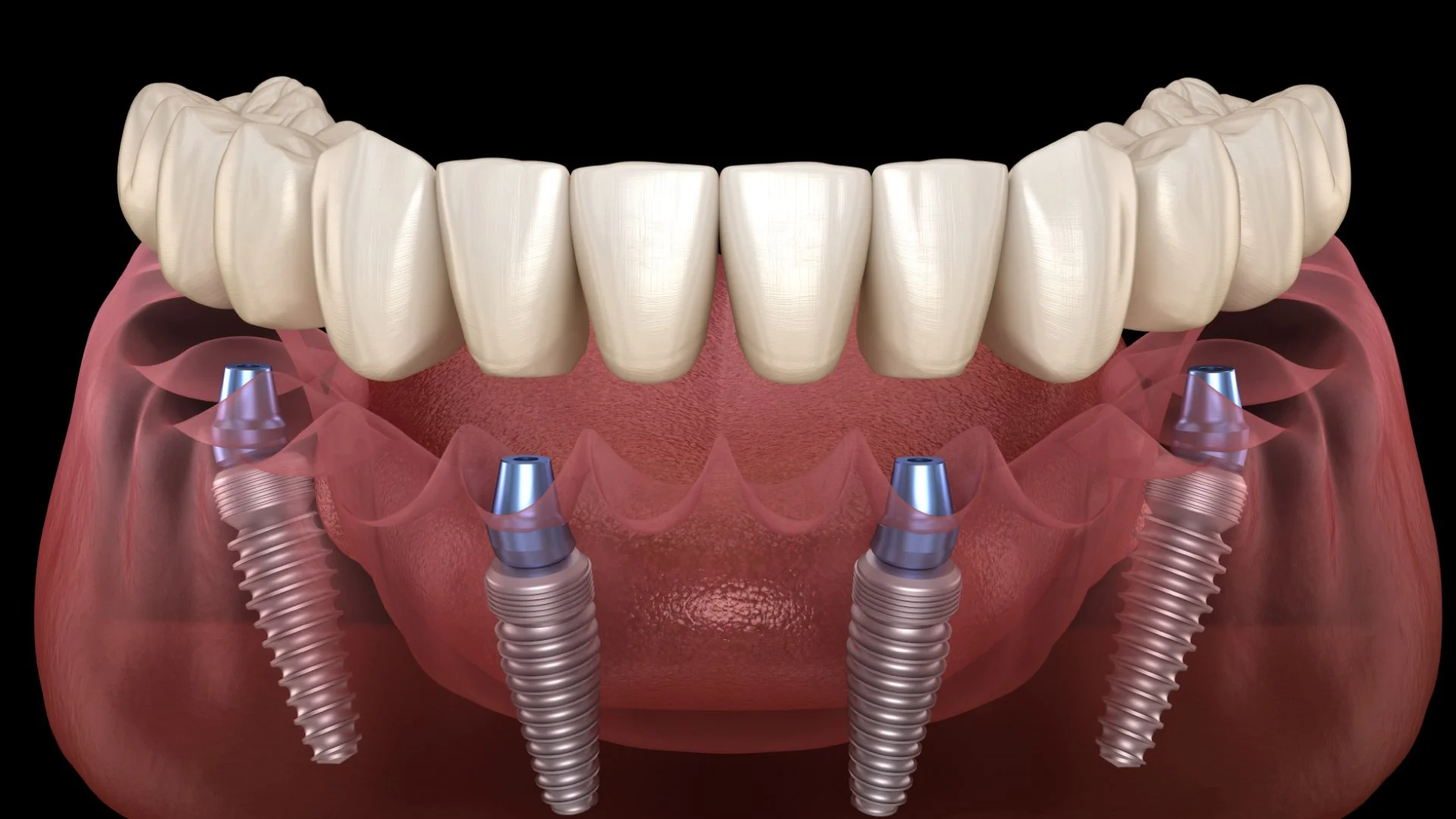All-on-4 vs All-on-6 Dental Implants: Which Is Better?
