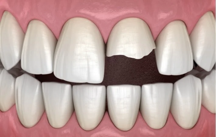 What Should I Do If I Have a Broken or Chipped Tooth?