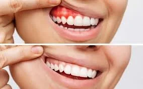 Gum Disease: Causes, Symptoms, and Treatment Options