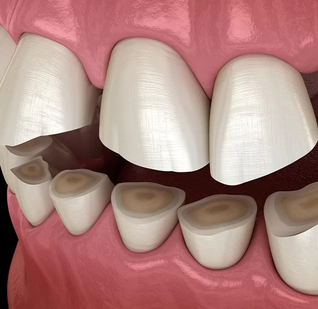 Bruxism: Understanding the Causes and Hidden Dangers of Teeth Grinding