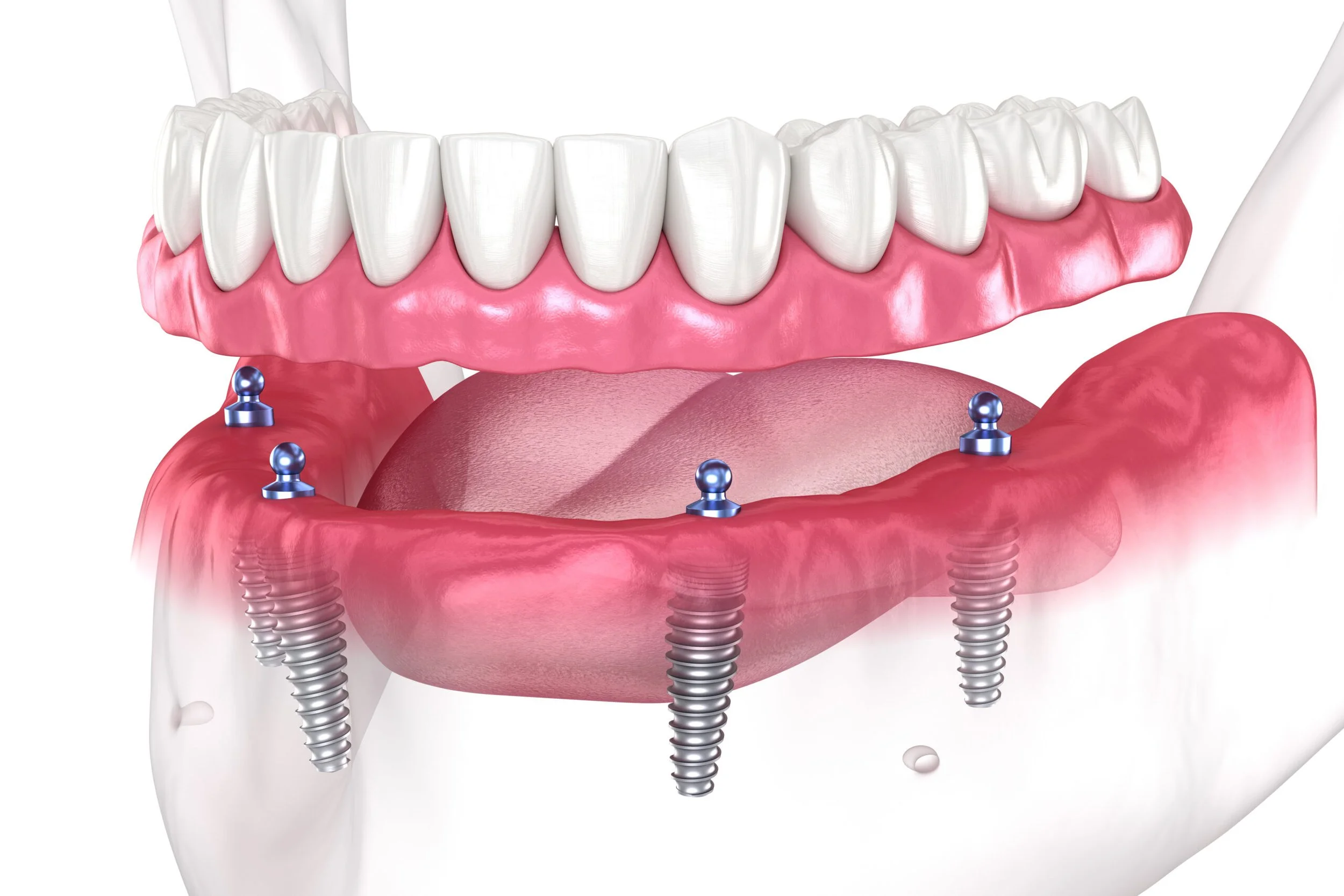 All-on-4 vs All-on-6: Choosing Your Full-Arch Dental Implant Solution