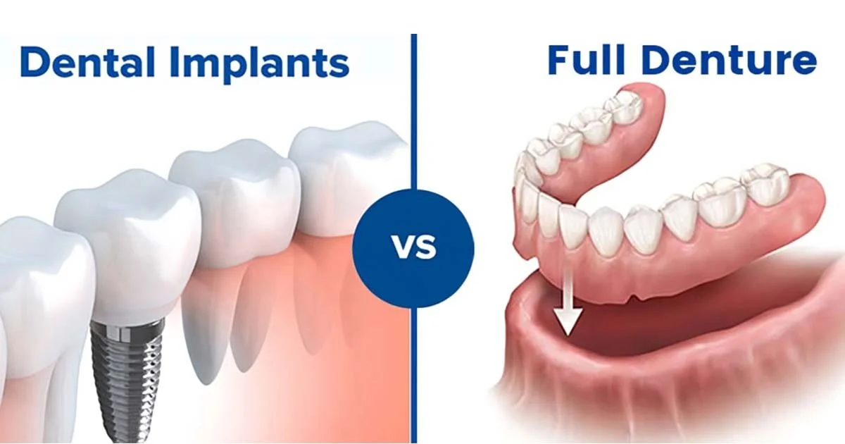 The Ultimate Smile Showdown: Implants vs. Dentures vs. Fixed Bridges