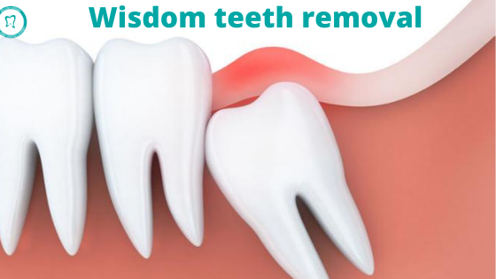Wisdom Tooth Pain: When to Act and How IV Sedation Can Save Your Sanity