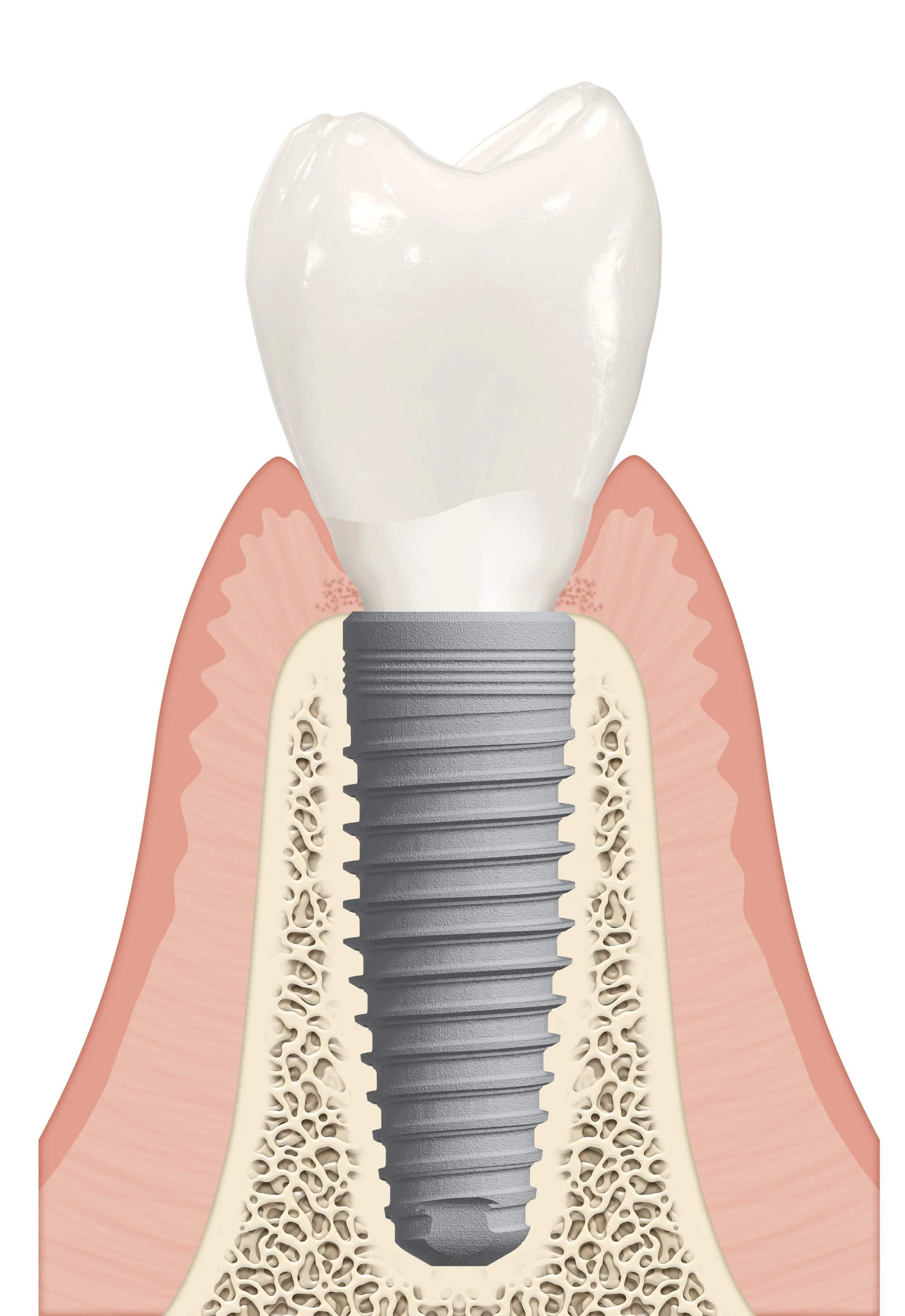 The Complete Guide to Dental Implants: Restoring Your Smile and Confidence