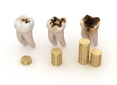 The High Cost of Ignoring a Cavity: Why a Small Filling Today Saves You Thousands Tomorrow