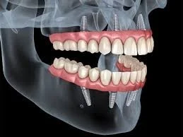 All-on-4 vs All-on-6 Dental Implants: What’s the Difference?