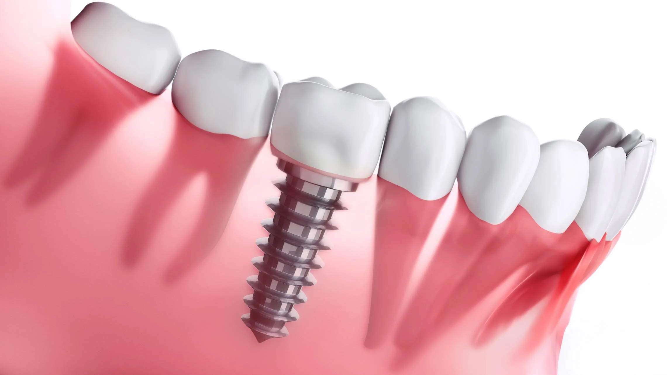 How Long Do Dental Implants Last? The Truth About Implant Longevity