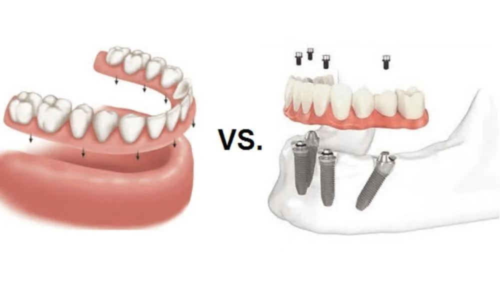 Dental Implants or Dentures? Which Tooth Replacement Option Is Right for You?
