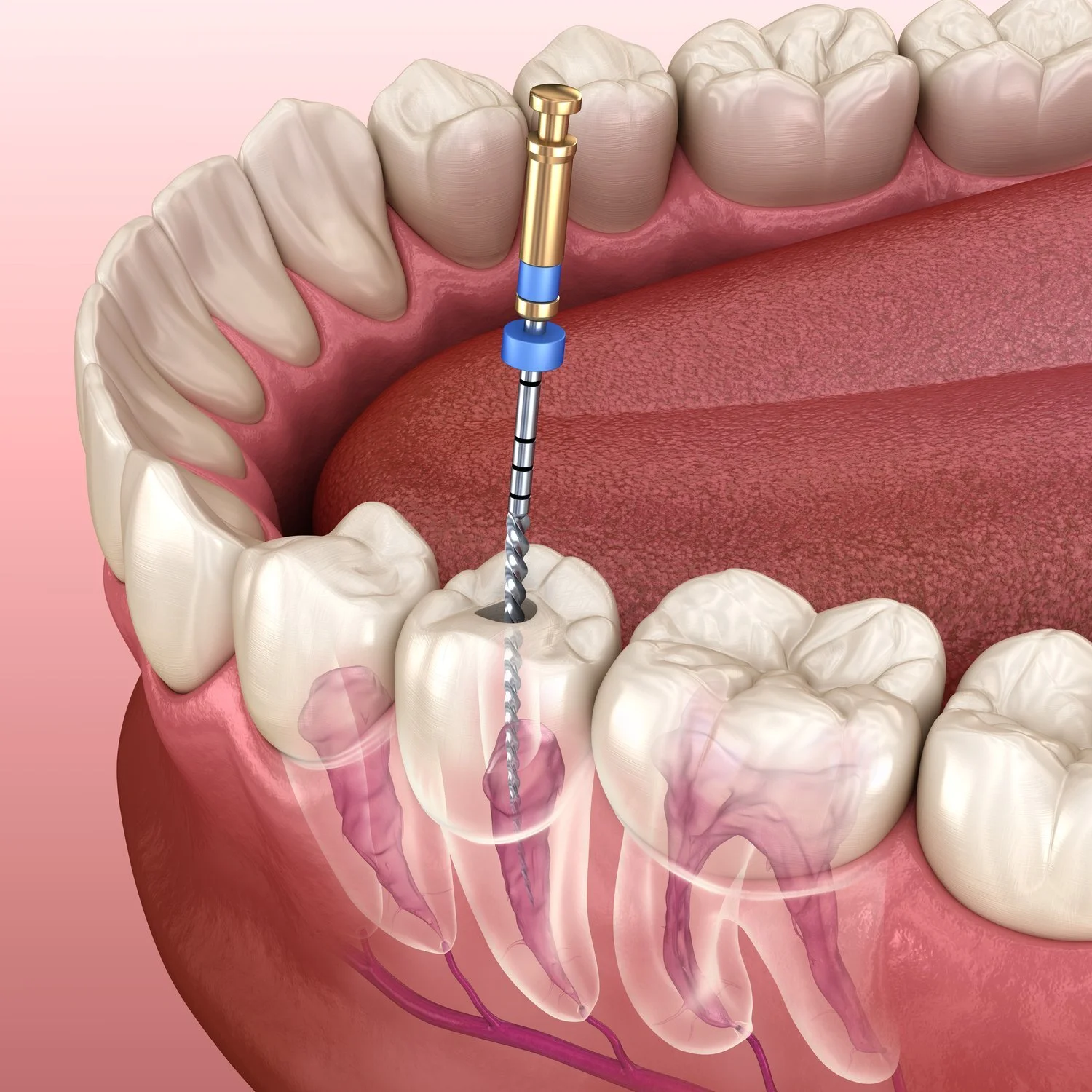 Do You Really Need a Root Canal? 7 Signs Your Tooth May Be in Trouble