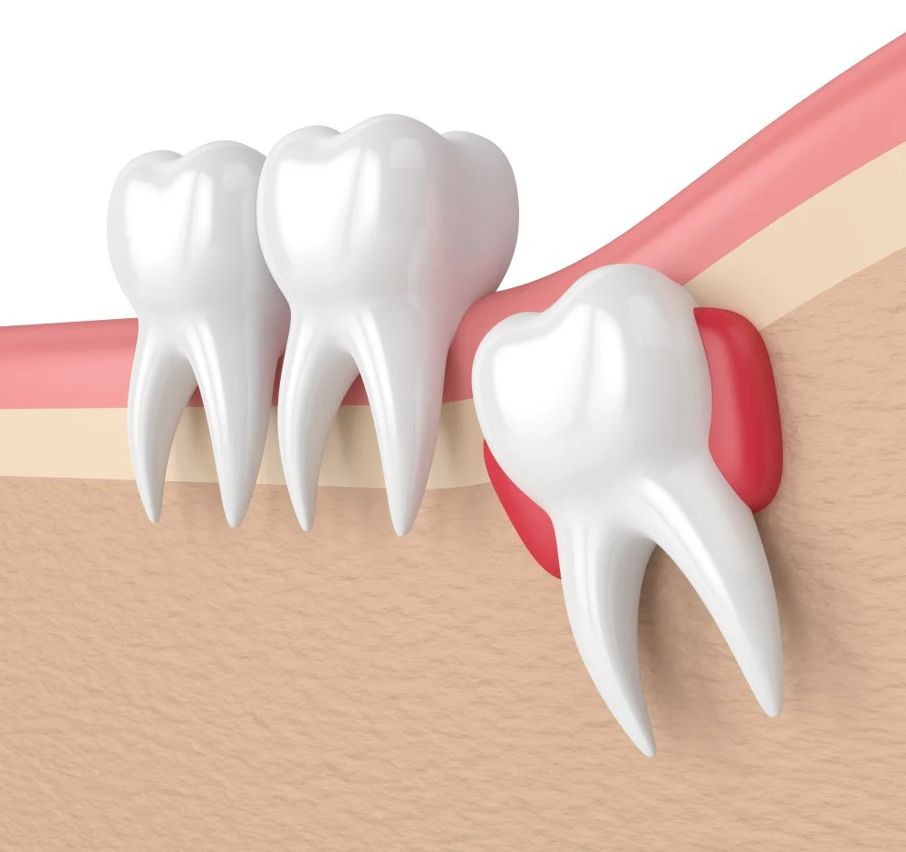 When Should You Remove Your Wisdom Teeth? Signs You May Need an Extraction