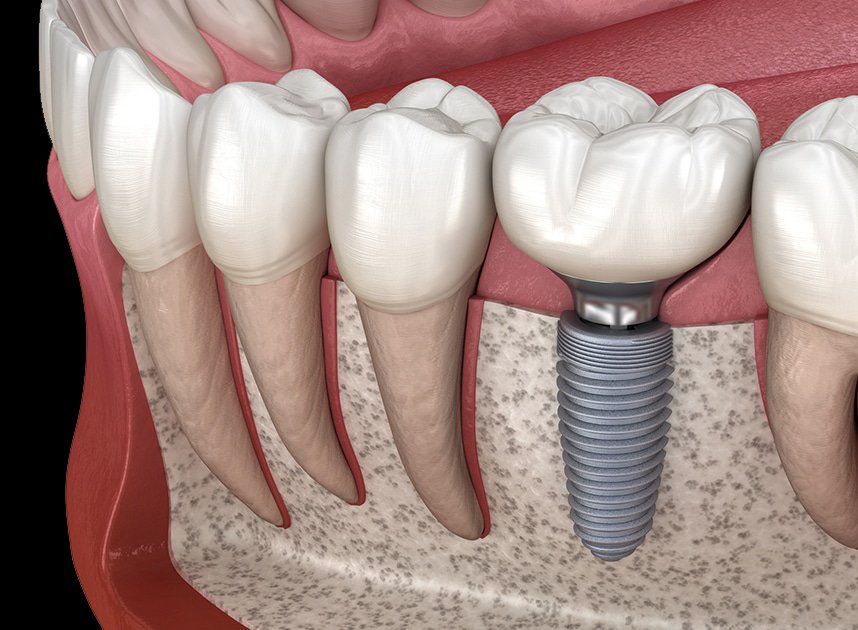 Dental Implants: What Nobody Tells You (But You Need to Know)