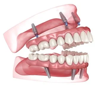 Why Dental Implants Are the Best Decision You'll Ever Make for Your Smile