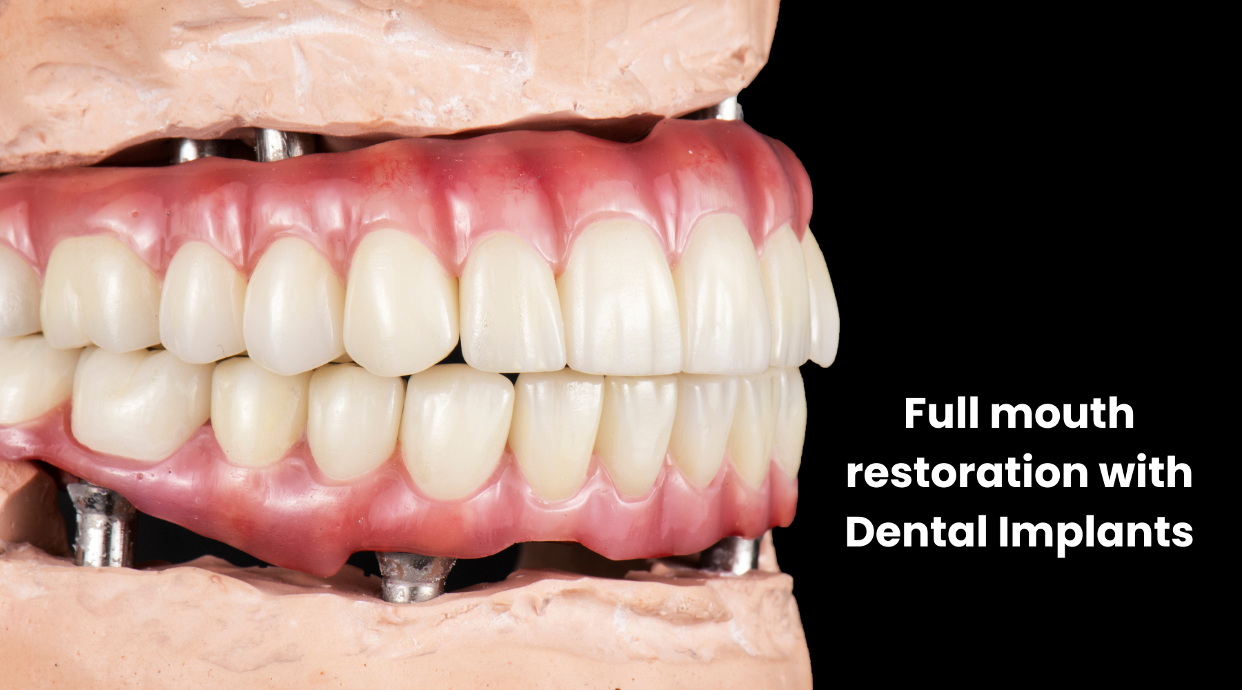 More Than a Smile: The Life-Changing Benefits of Dental Implants
