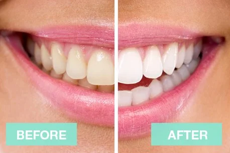 Professional Teeth Whitening: Your Complete Guide to a Brighter Smile