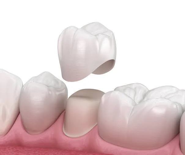 Crown vs. Filling: Why Does Your Dentist Recommend a Crown?