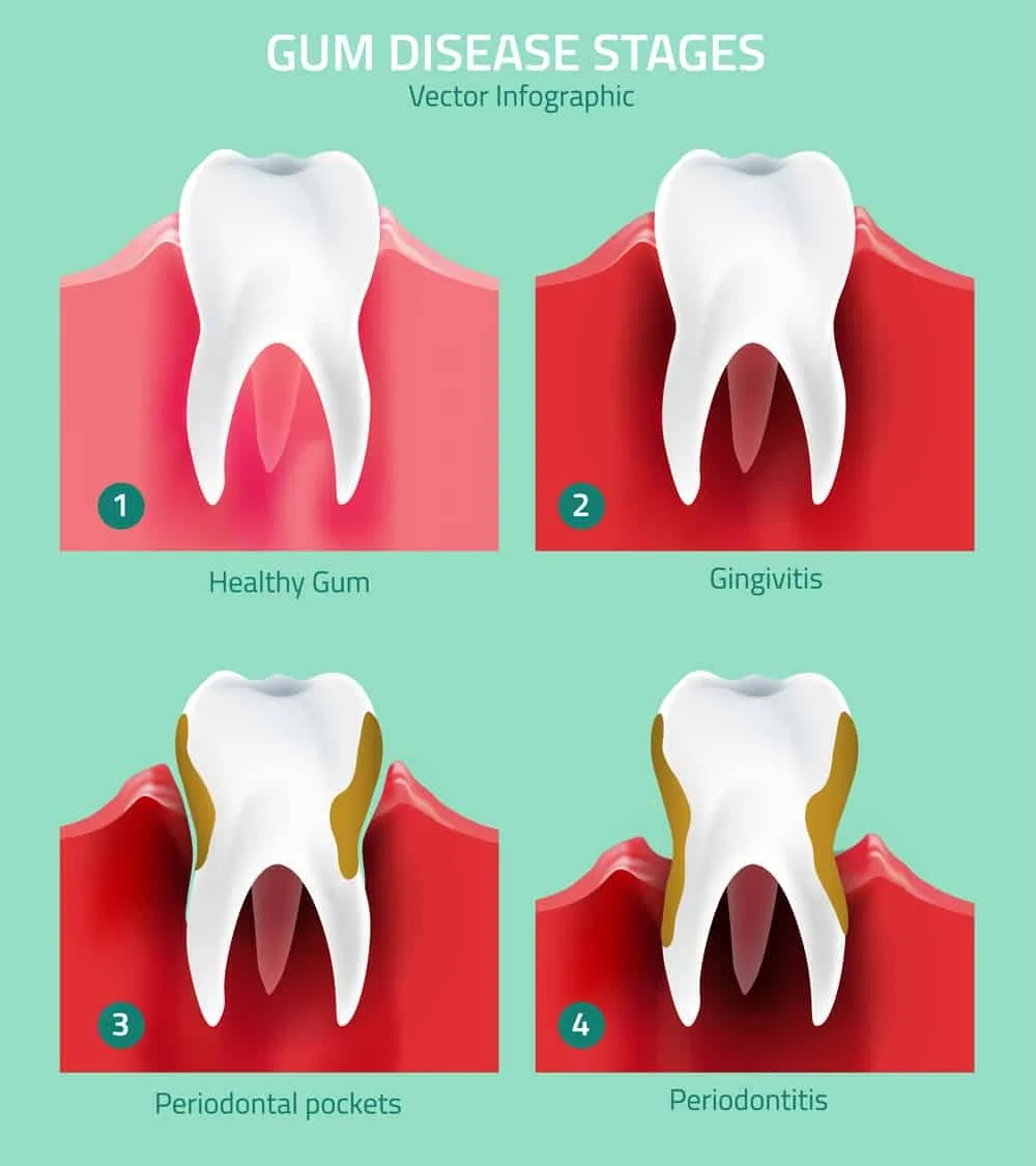 Why Do My Gums Bleed When I Brush? (And When to Worry)