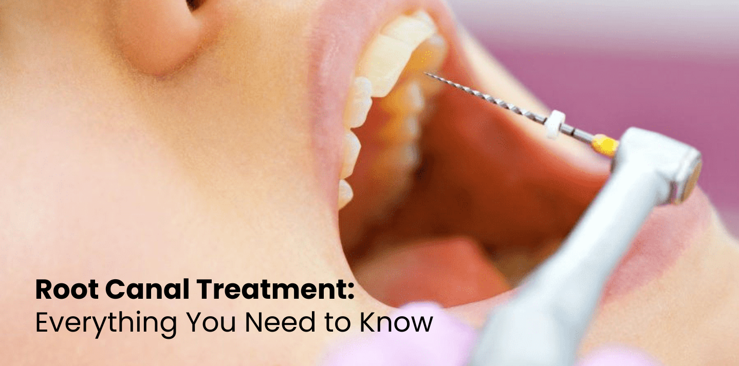 Root Canal Myths Busted – What It Really Feels Like