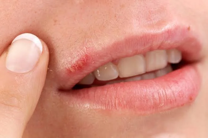 Cold Sore Treatment in Sydney: How Gemini EVO Laser May Help