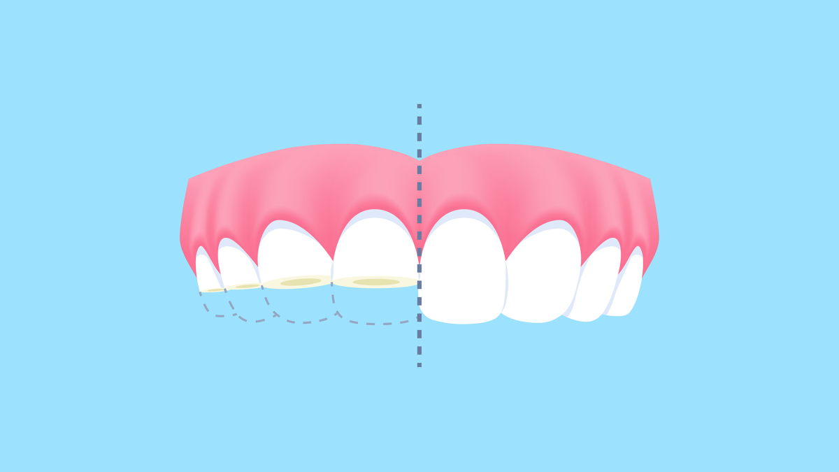 Worn Down Teeth From Bruxism: Why Does Teeth Grinding Cause Tooth Wear?