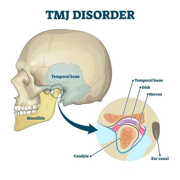 TMJ Dysfunction & Sleep Apnea: The Hidden Connection in Sydney's Inner West