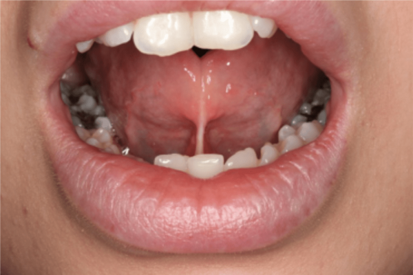Adult Tongue Tie: How a Simple Band of Tissue Can Impact Your Daily Life