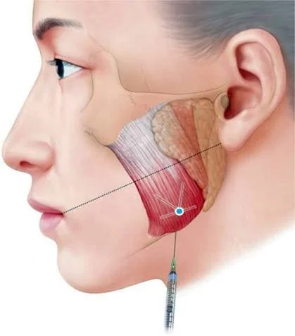 TMJ Botox: Can Botox Help Jaw Pain, Clenching and Teeth Grinding?
