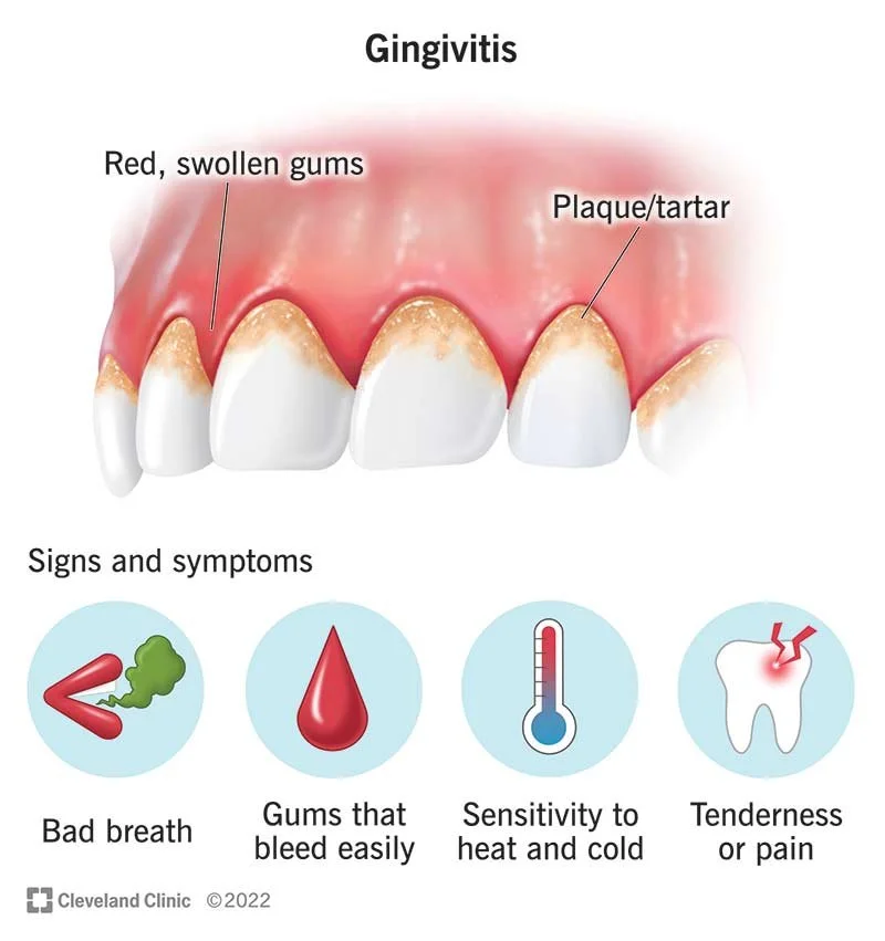 Gum Disease Sydney: Signs, Causes and Treatment