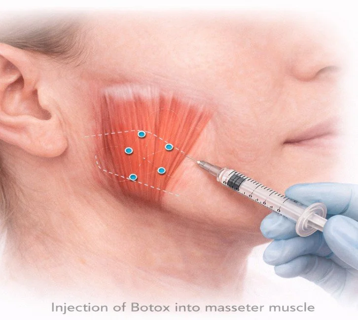 Botox for TMJ Problems: Can It Help Relieve Jaw Pain, Teeth Grinding and Headaches?