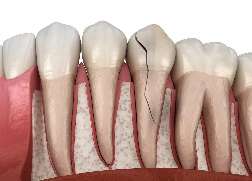 Cracked Tooth Syndrome: Why Does Your Tooth Hurt When You Bite Down?