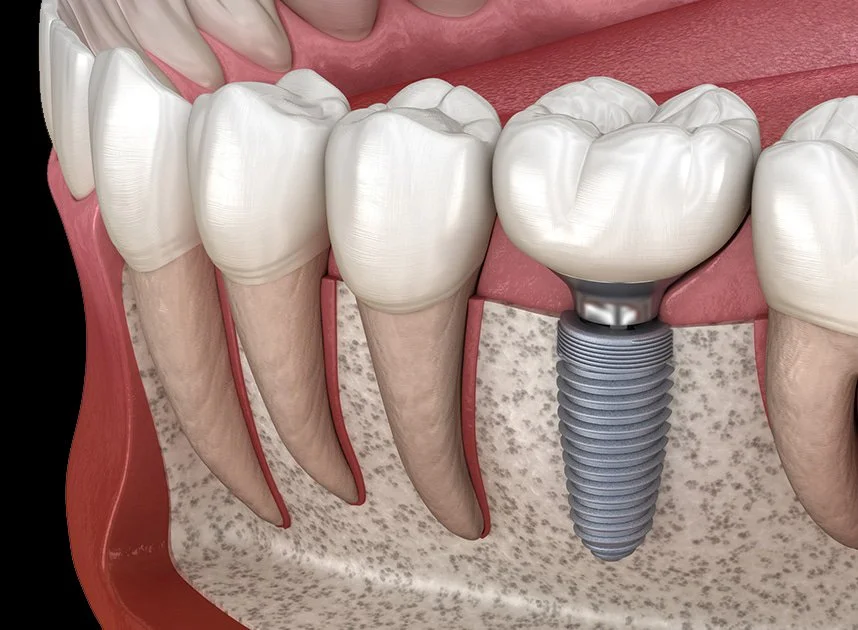 Dental Implants in Sydney: A Complete Guide to Replacing Missing Teeth