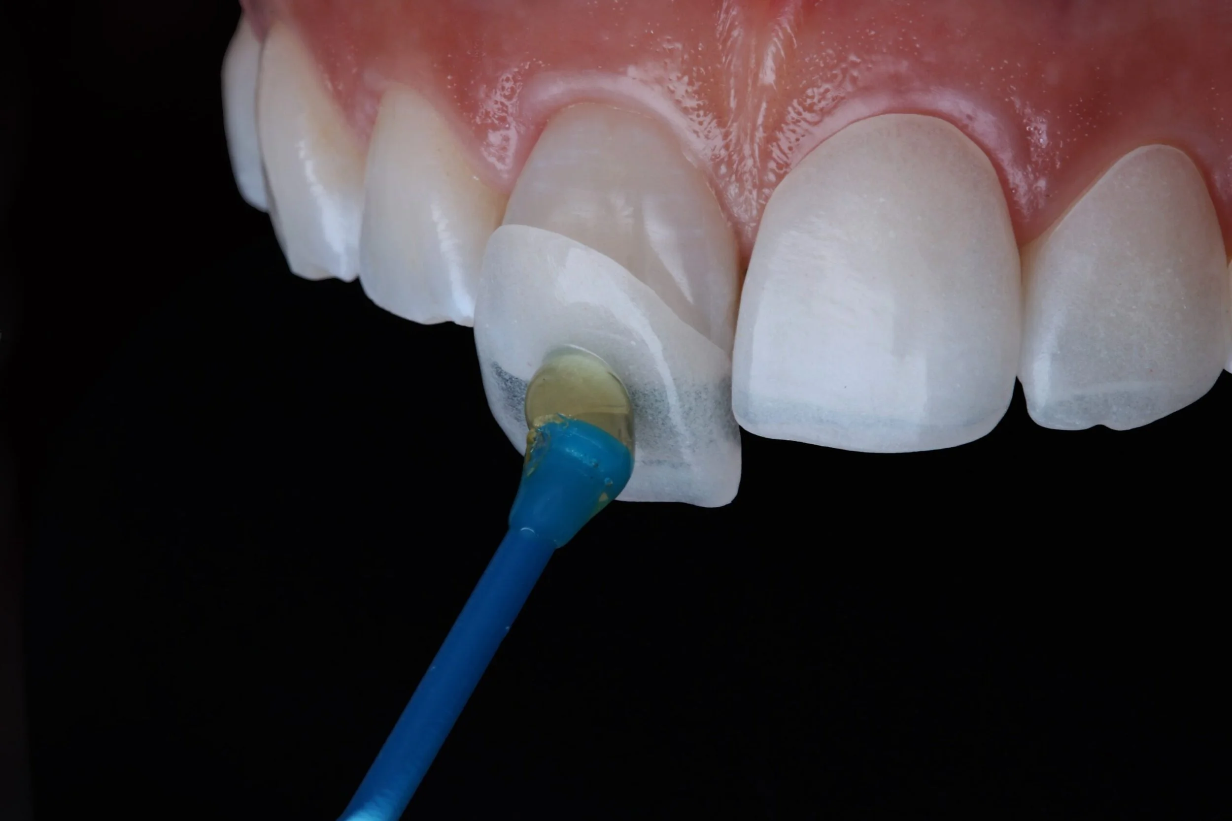 Dental Veneers in Sydney: Transform Your Smile with a Natural-Looking Result