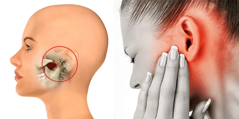 TMJ Disorder: How It Can Ruin Your Everyday Life Without You Realising