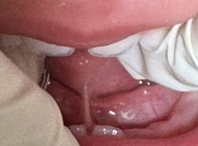 Baby Tongue-Tie: Could Your Baby’s Feeding Difficulties Be Related to a Restricted Tongue?