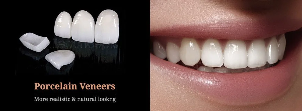 Veneers! Are they a fit for you?