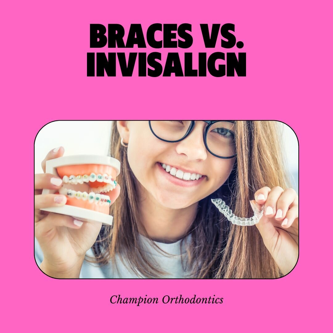 Thinking about improving your smile but don't know where to begin? Here we highlight the benefits of Invisalign over braces. Both are great options, which one do you prefer? 

#info #dentist #orthodontist #braces #invisalign #promo #raleigh #northcar