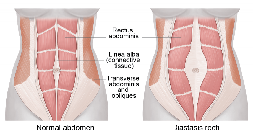 Diastasis Recti: What to Do? — Ellie Herman Pilates