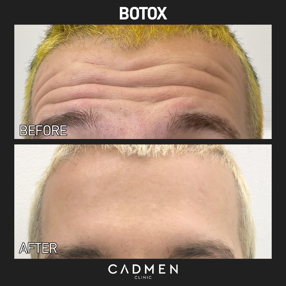 Botox