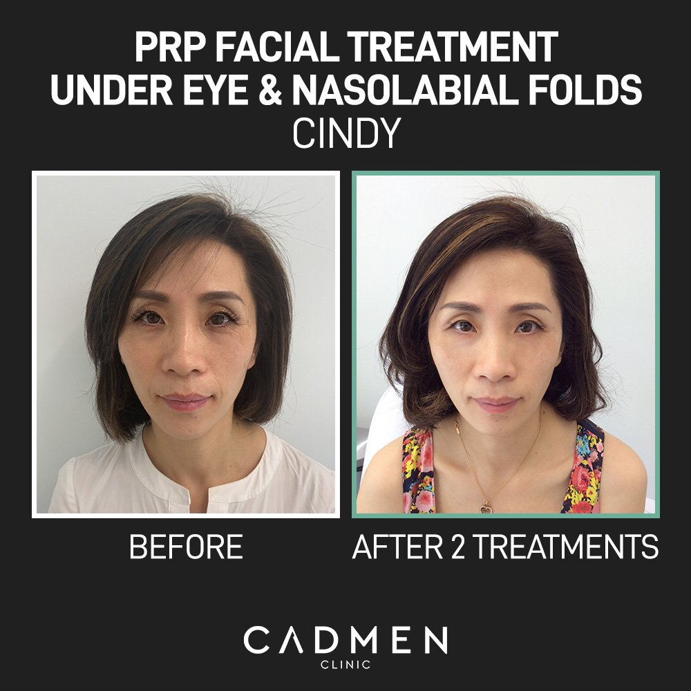 PRP Facial and Microneedling