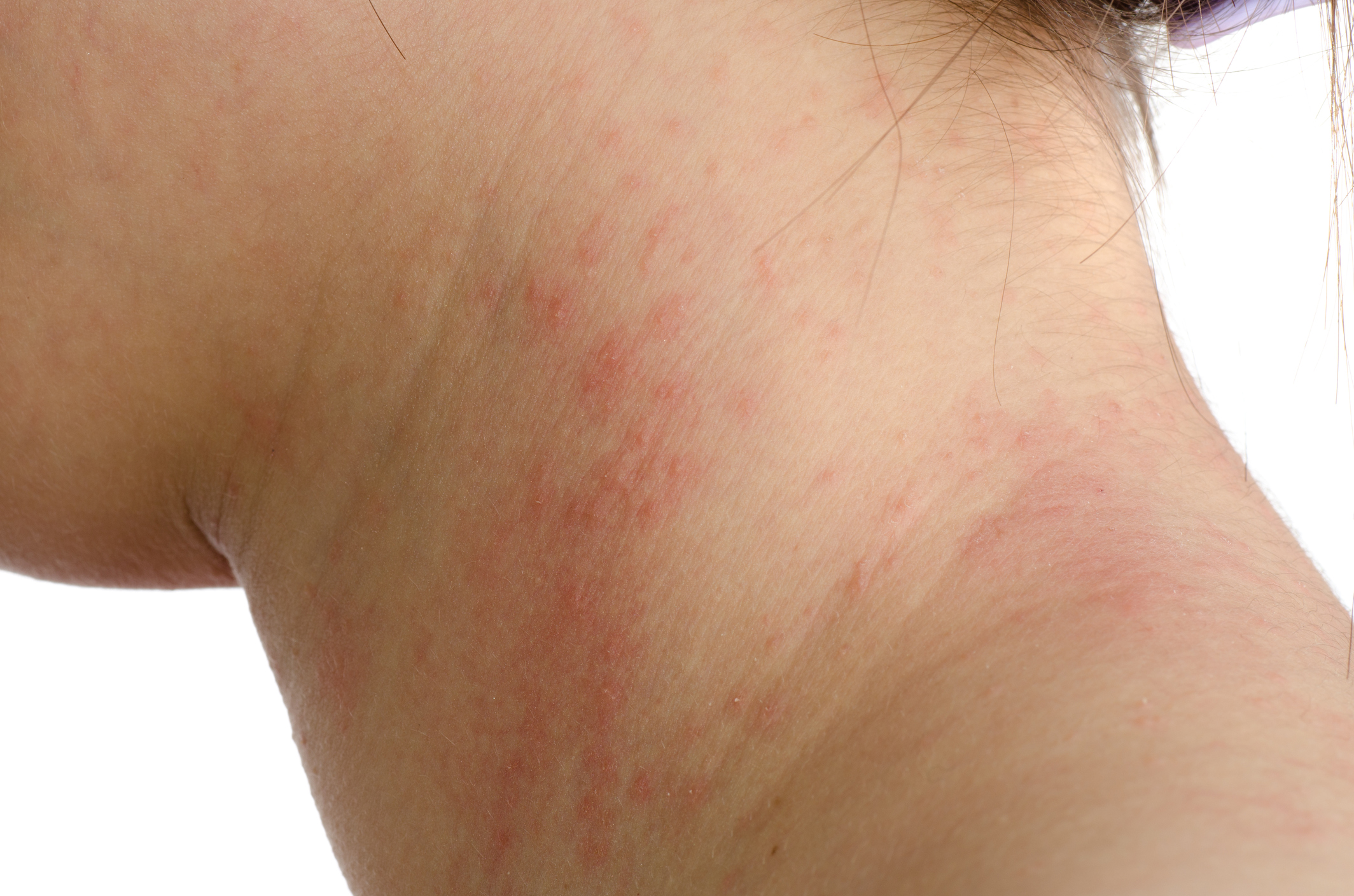 This type of skin rash is classifed as a mild allergic reaction.