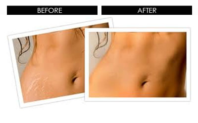 Here is an example of dermaRolling performed on the tummy area of a woman who had untreated stretch marks. DermaRolling can be done anywhere on the body where collagen stimulation is required to improve the elasticity and appearance of the skin.