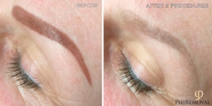 Phiremoval - Remove Old Permanent Makeup and unwanted tattoo with the newest non-surgical technique