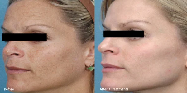 microneedle-before-and-after.jpg