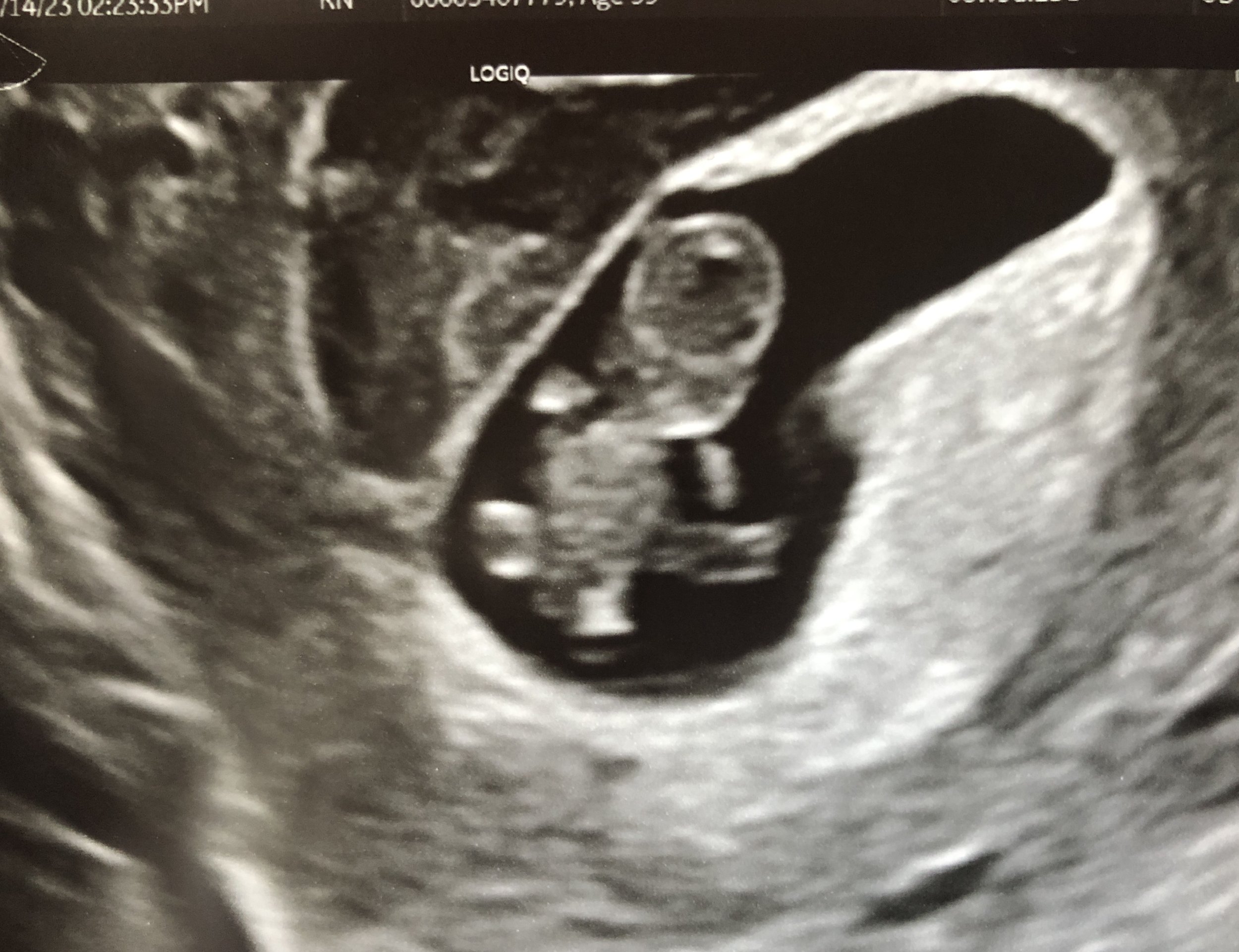  Nessa Goldman’s most recent ultra sound. Nessa has officially hit the end of her first trimester. Photo courtesy of Nessa Goldman.  