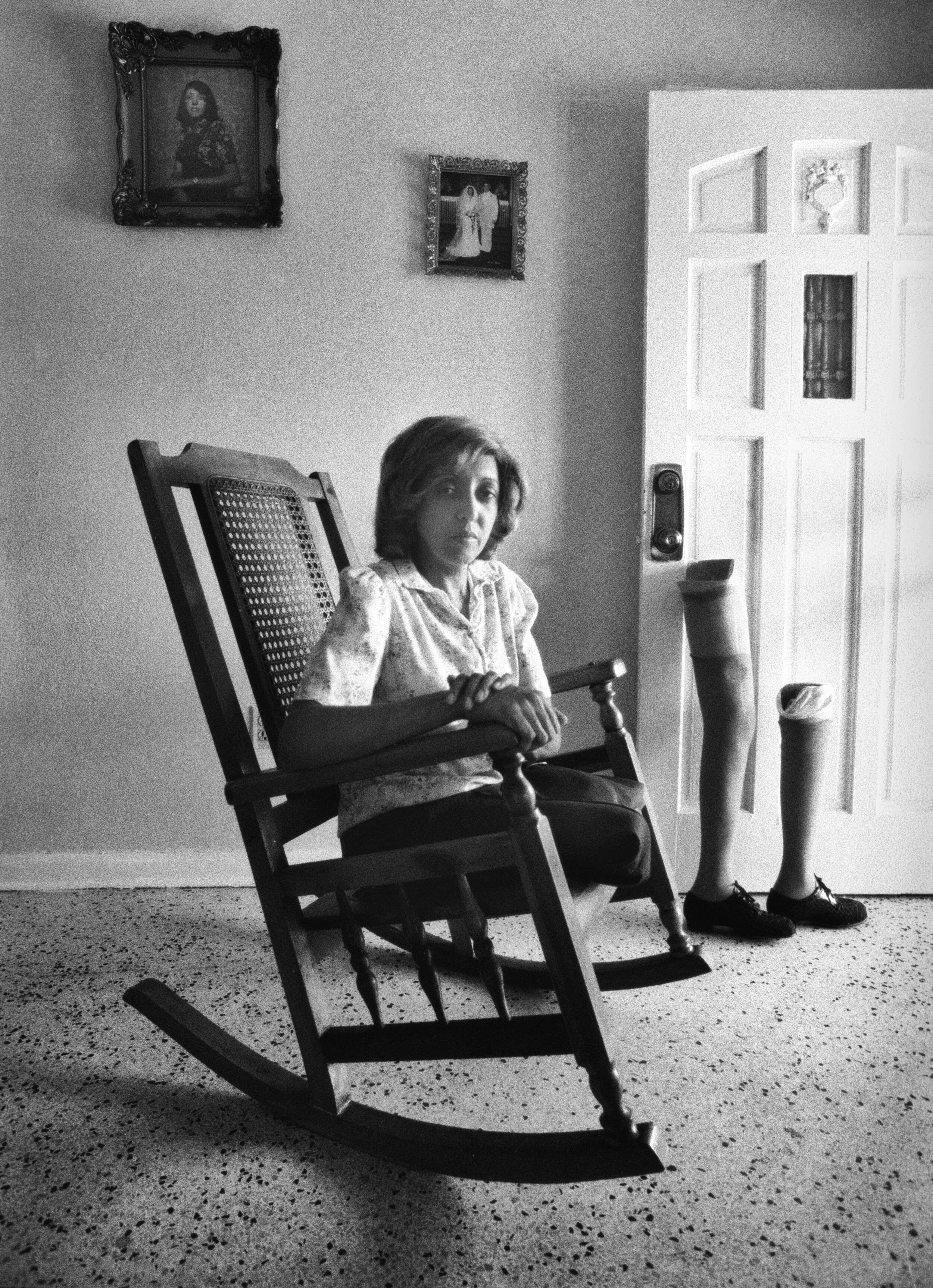  Waiting for new prosthetics. Miami. 